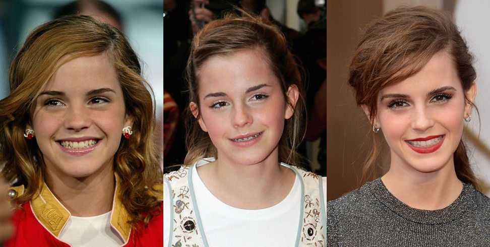 Braces before and after