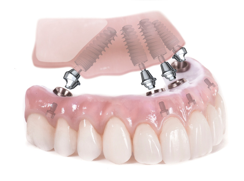 basal dental implantation at Bagita Clinic