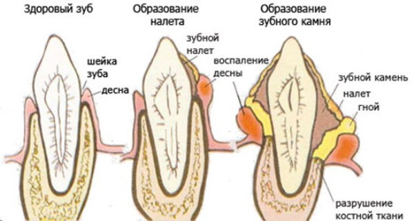 dental calculus