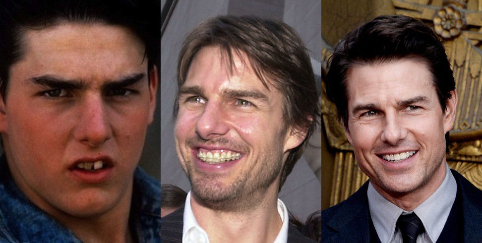 Braces before and after