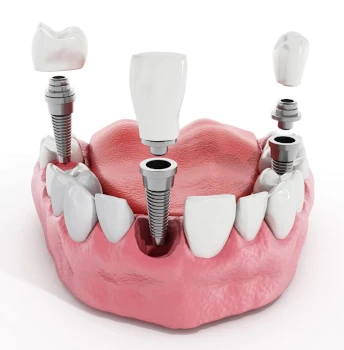 a surgical instrument for treating and extracting teeth is shown