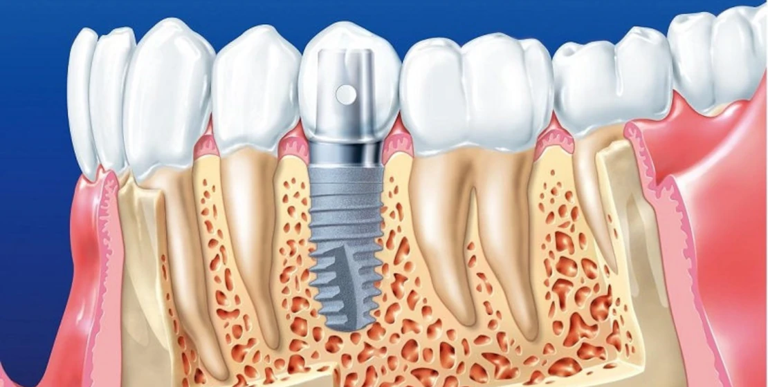 Dental treatment and implantation in Cherkassy and the region