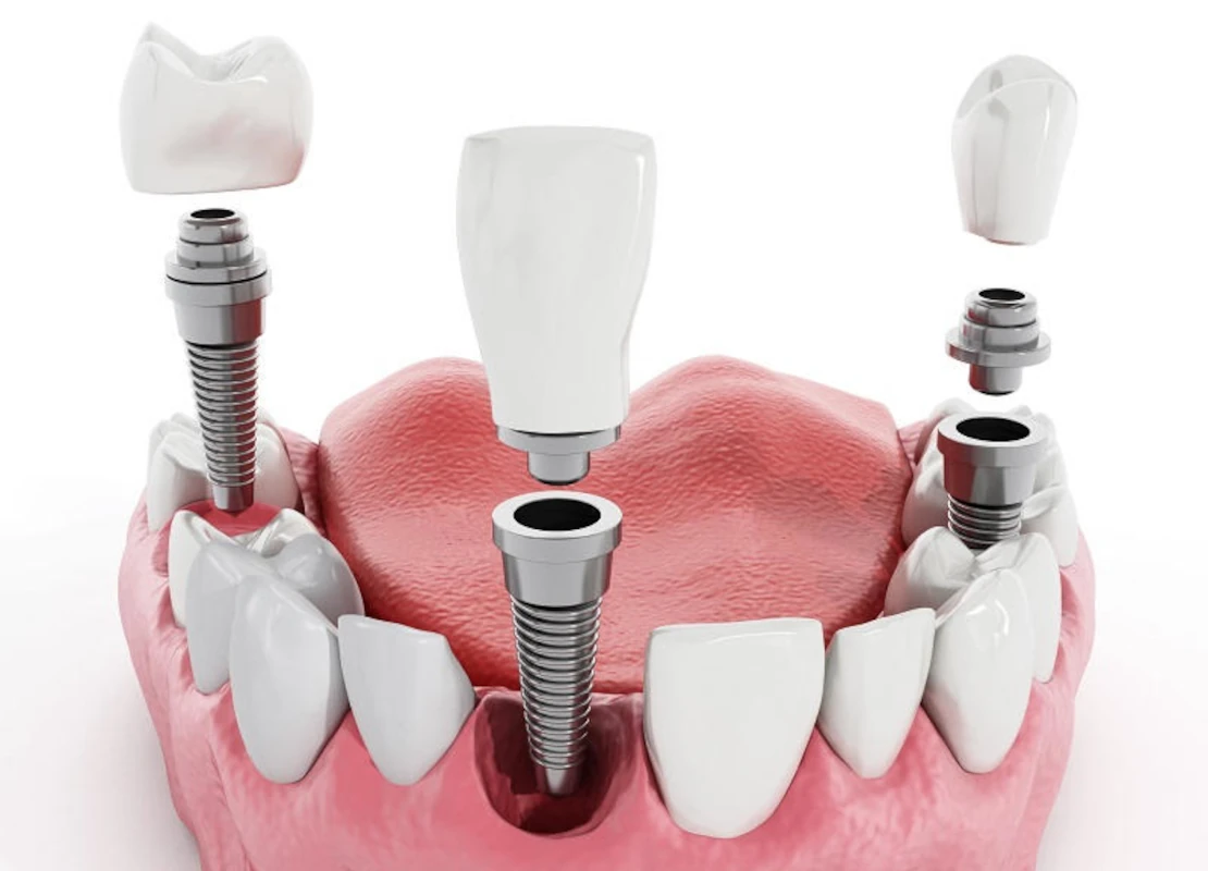 Dental treatment and implantation in Cherkassy and the region