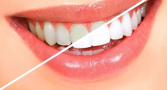 photo of teeth before and after whitening at Bagita Dental Clinic