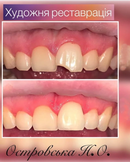 Cтоматологічна клініка «Багіта» Імплантація зубів