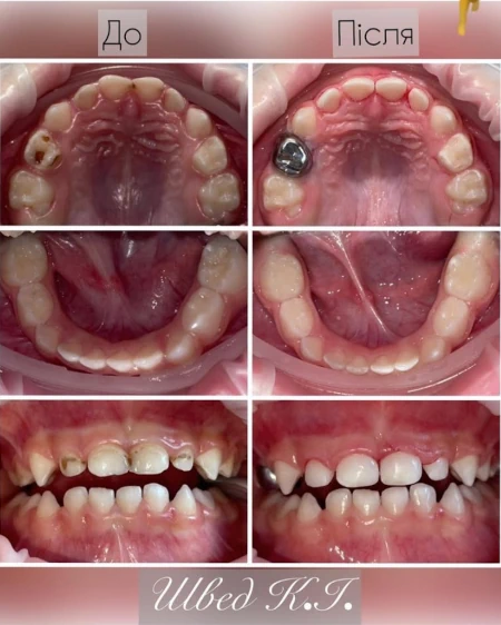 Імплантація зубів Cтоматологічна клініка «Багіта»