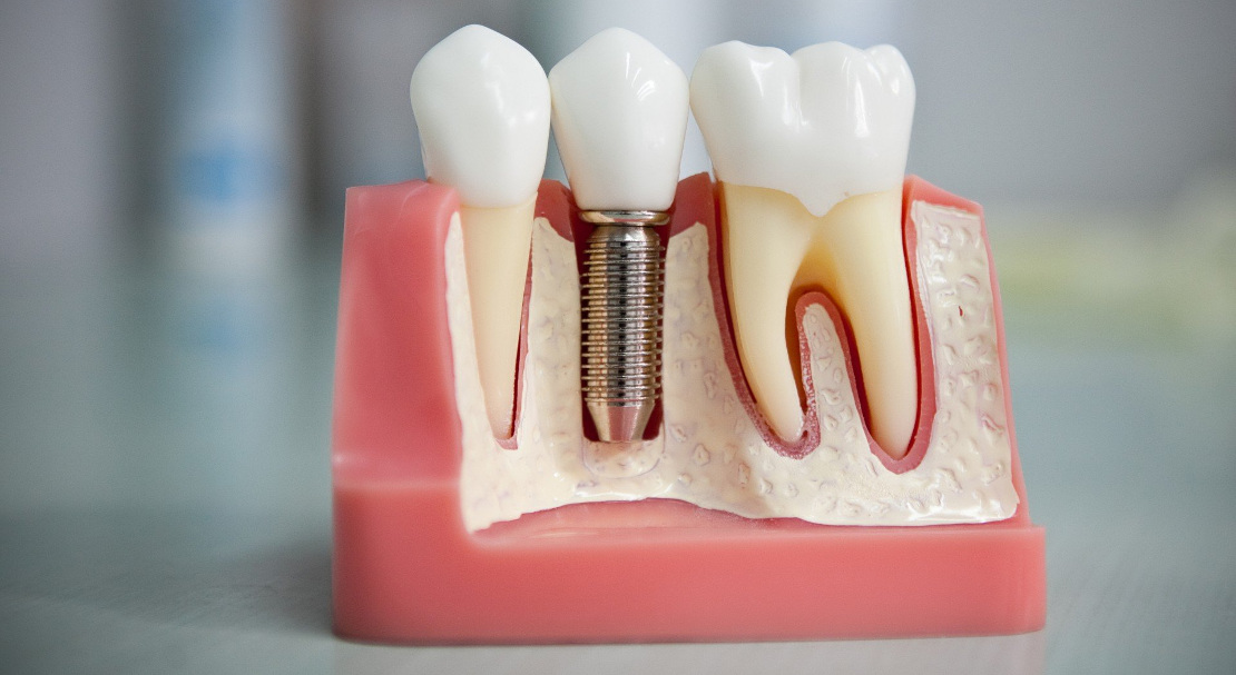 dental implantation at Bagita Dental Clinic in Cherkassy