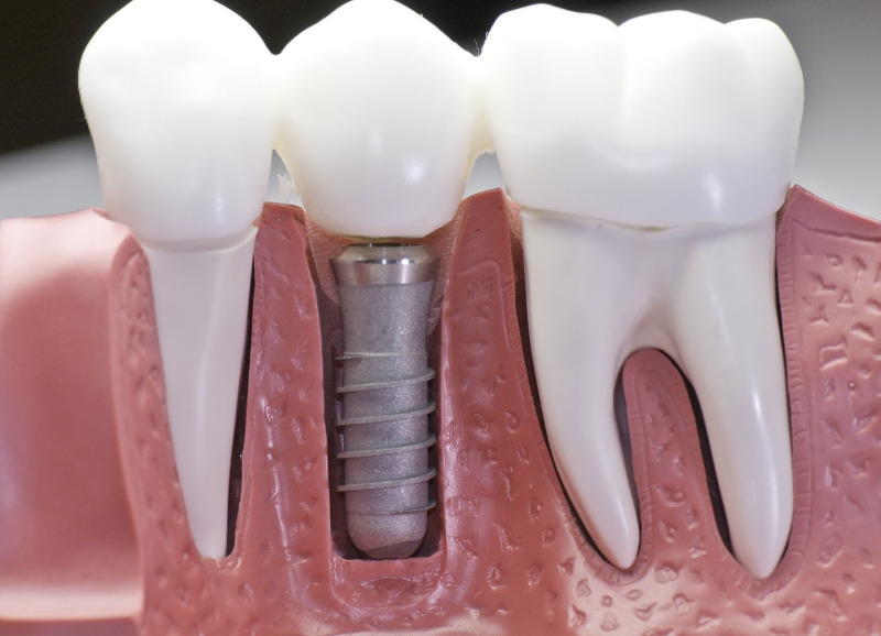 dental implant scheme in the dental clinic Cherkassy