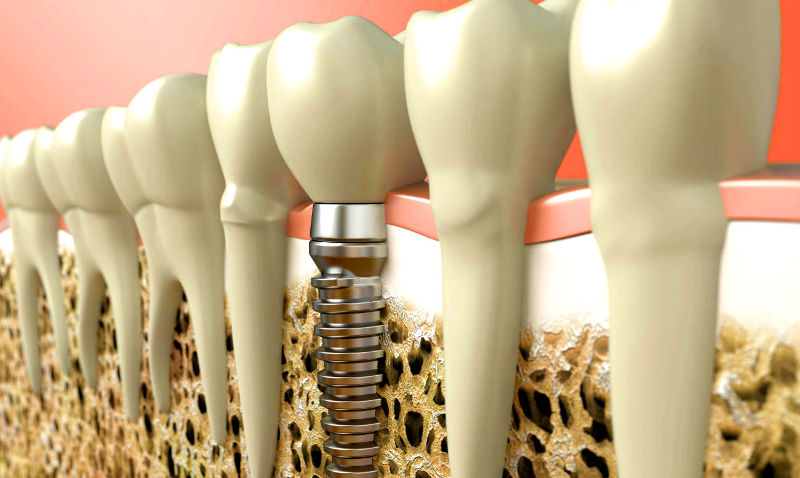 implantation in Ukraine