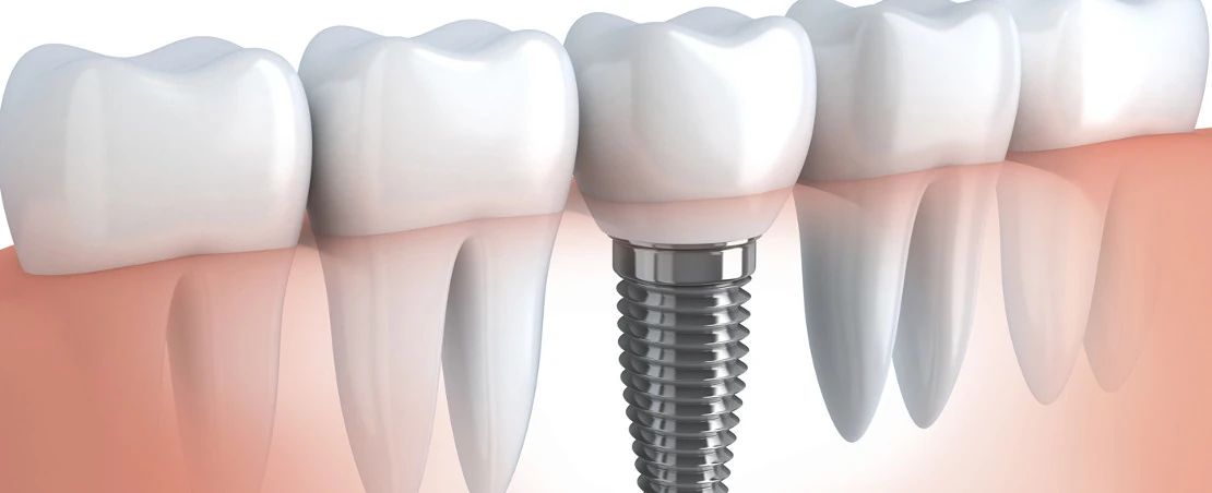 on the photo is an implant installed in the Bagita Dental Clinic in Cherkassy.