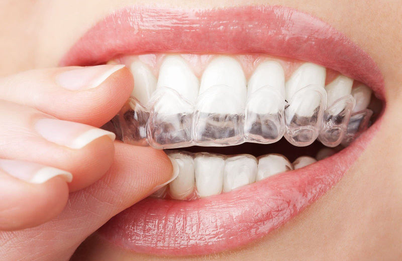 Bite correction mouth guard at Bagita Dental Clinic in Cherkassy