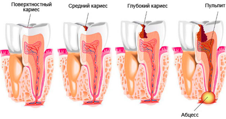 caries symptoms