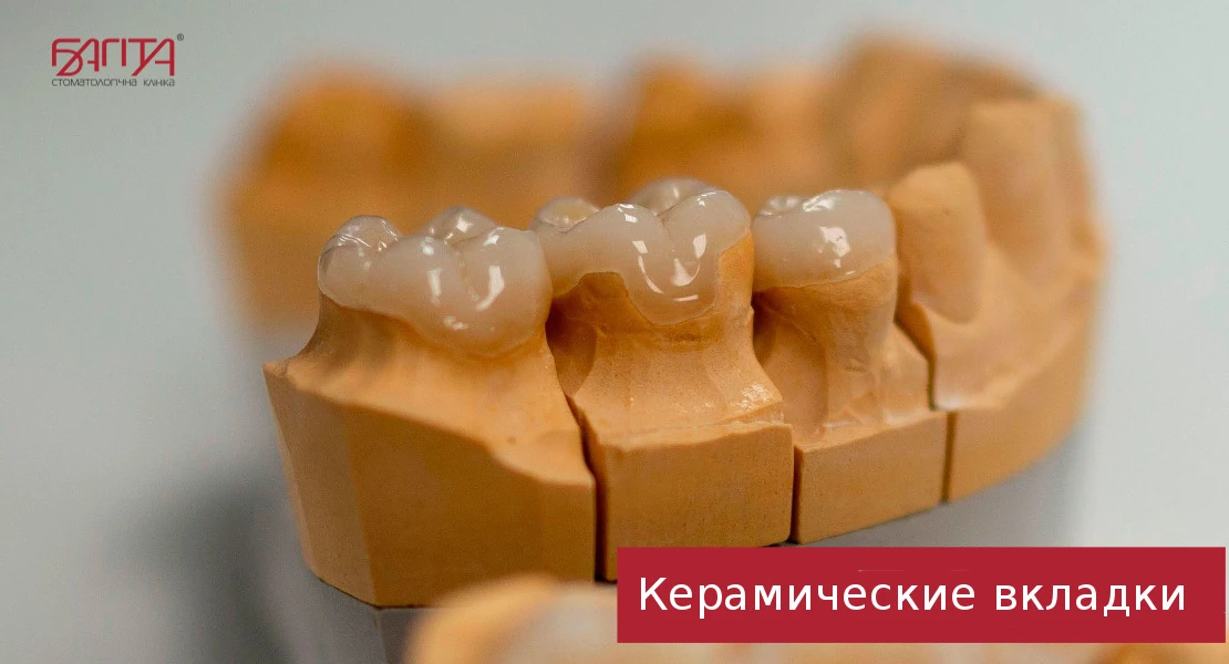 Ceramic inlays for dentures in Cherkassy at Bagita Dental Clinic