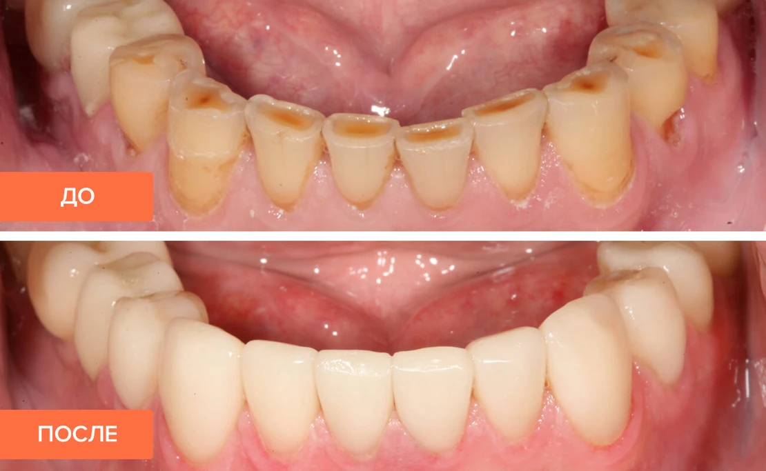 Dental crowns installed at Bagita Dental Clinic