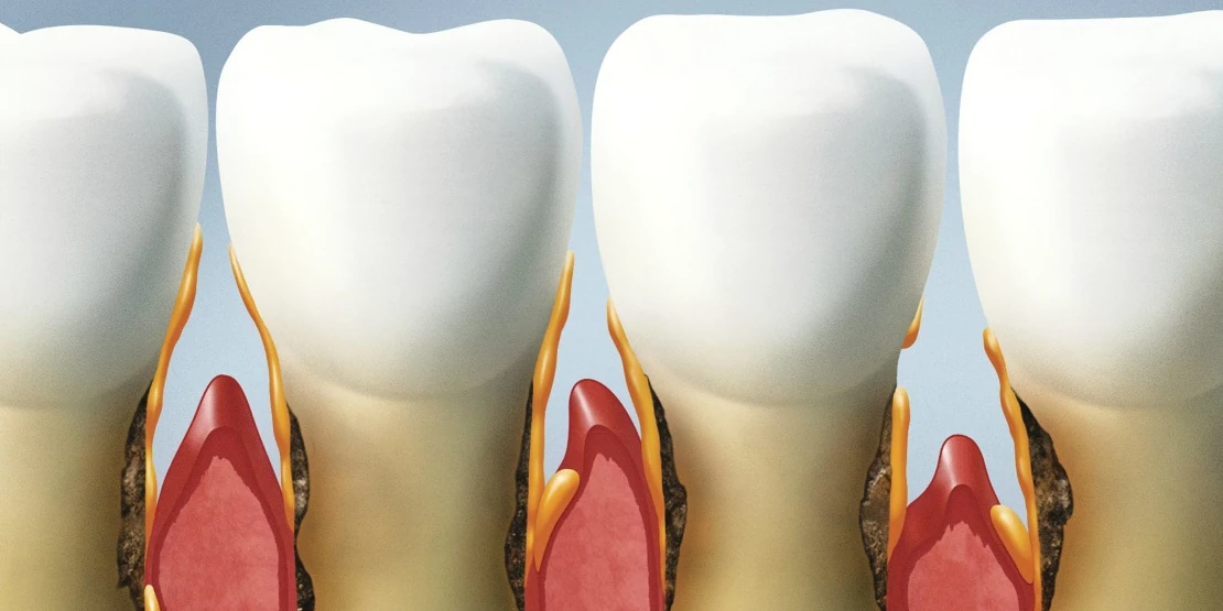 photo of teeth and dental instruments for periodontitis treatment