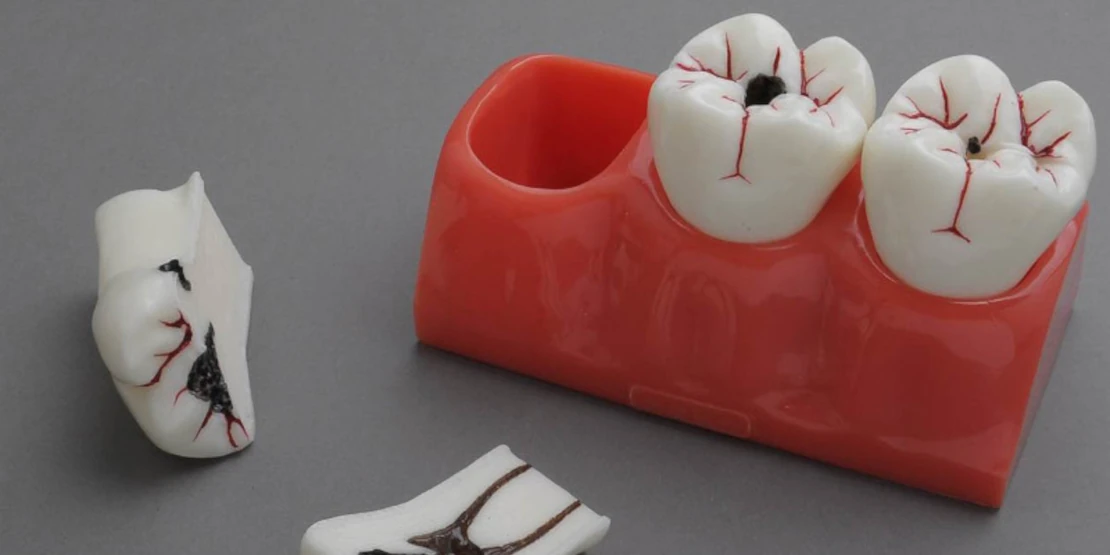 tooth decay