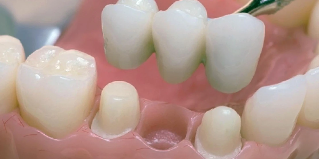 bridges for restoring teeth at the dental clinic in Cherkassy