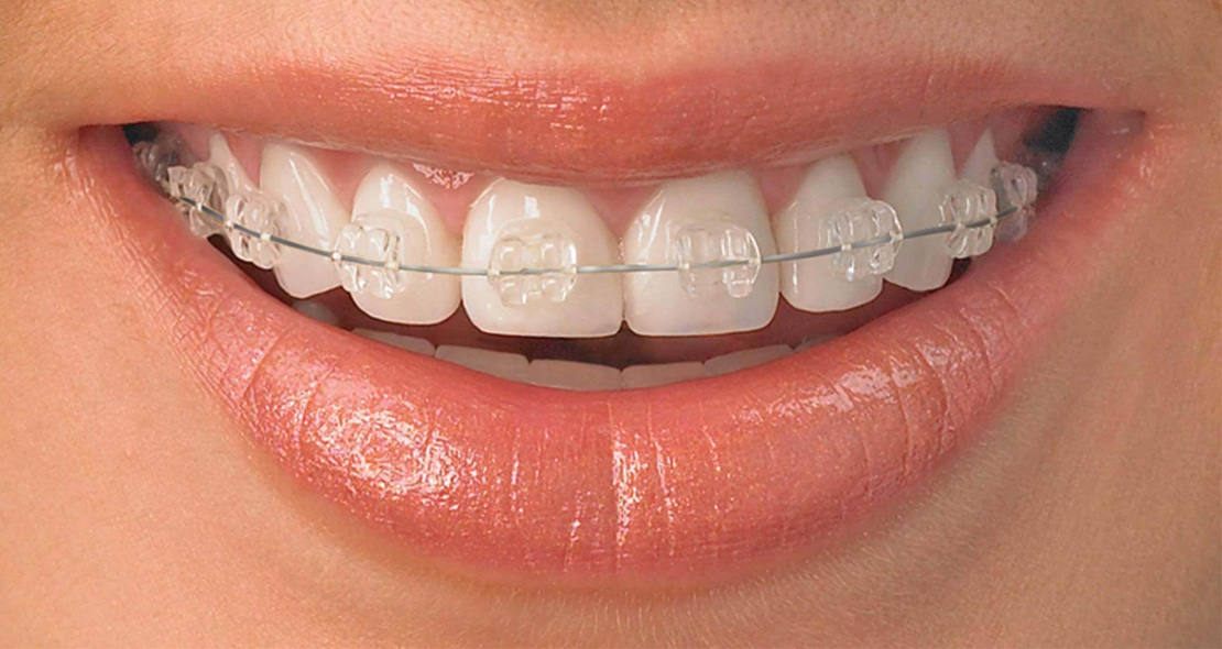 orthodontic braces at Bagita Dental Clinic in Cherkassy