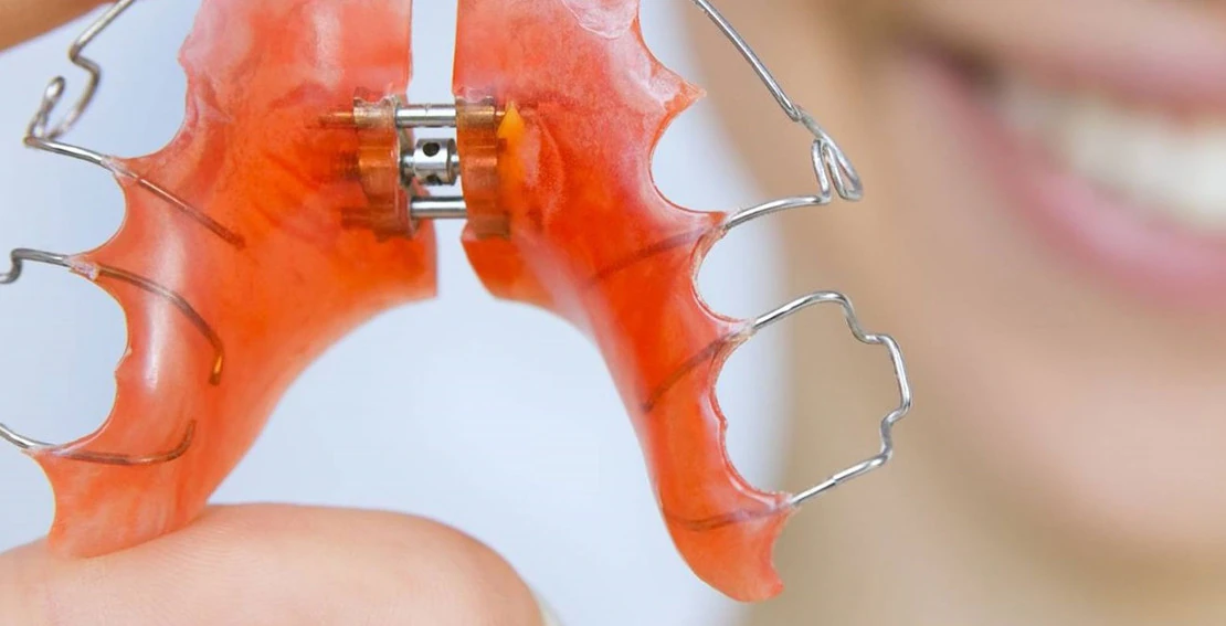on the photo orthodontic plates for bite correction in Cherkassy orthodontist in clinic Bagita