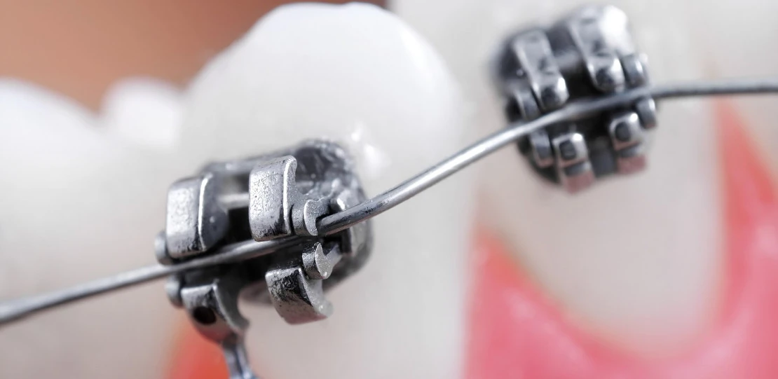 on the photo braces installed at the orthodontist with an orthodontic arch for bite correction