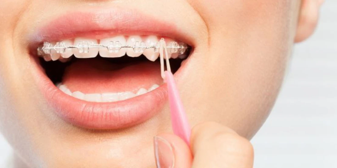 orthodontic elastics for braces photo
