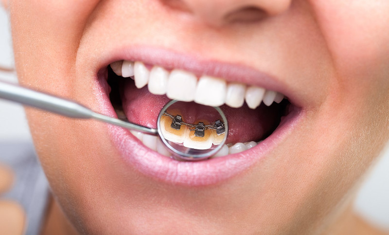 Orthodontic plate on teeth in the dental clinic Cherkassy photo