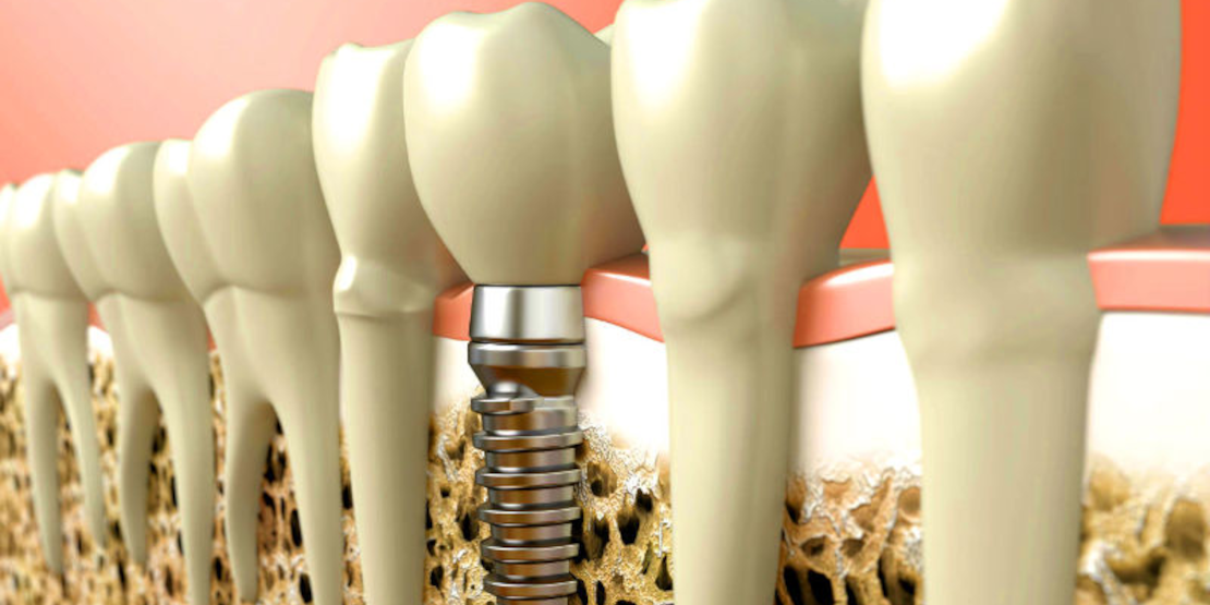 implantation in Ukraine