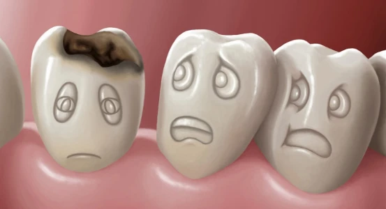 picture of a decayed tooth