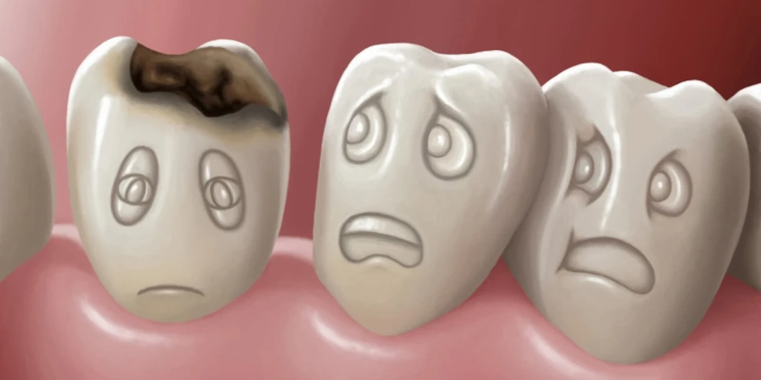 picture of a decayed tooth