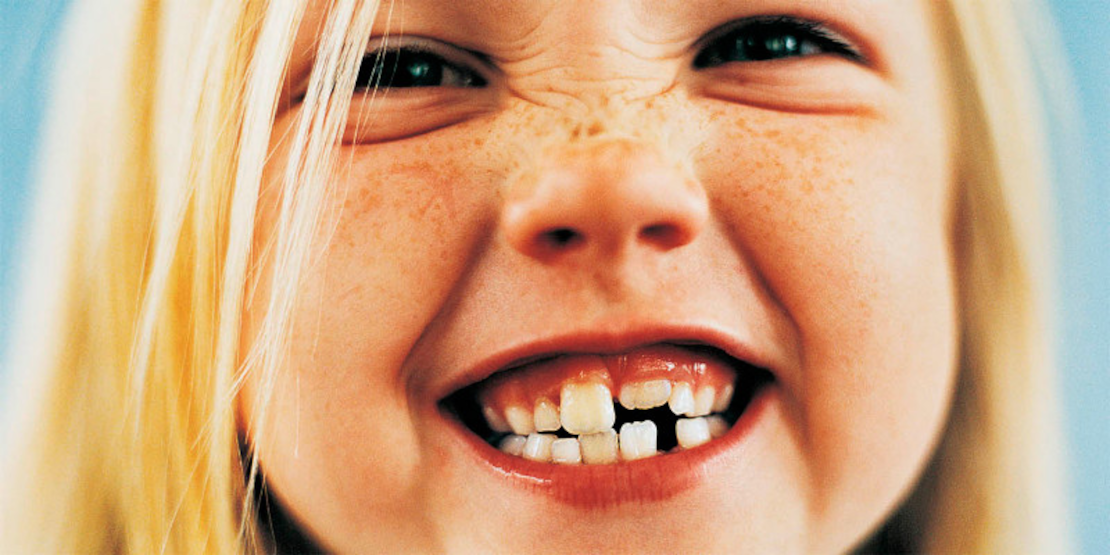 malocclusion