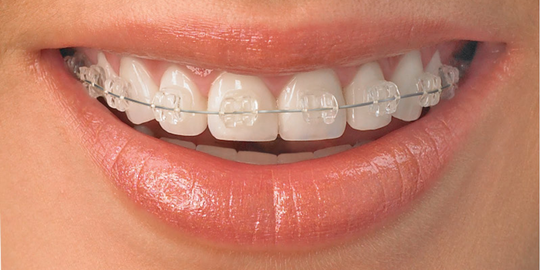 bite correction with braces