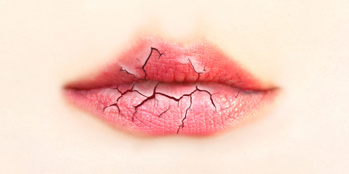photo of chapped lips and mouth stomatitis