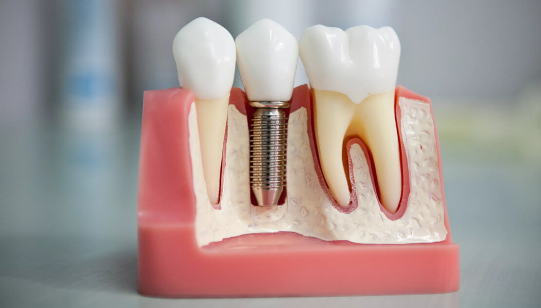 The photo shows a mock-up of an implant inserted into the jaw by a dental surgeon.