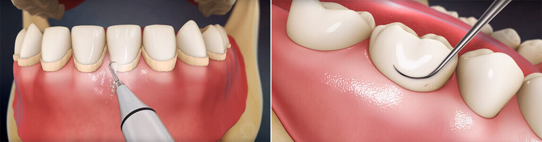 on the photo professional teeth cleaning by dental hygienist in Cherkassy