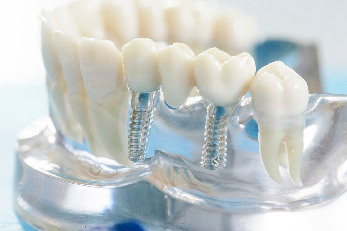 on the photo mock-up of implant prostheses for tooth restoration in Cherkassy dentistry