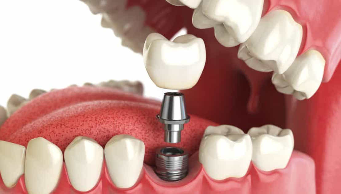 Dental implantation in Cherkassy at Bagita Dental Clinic