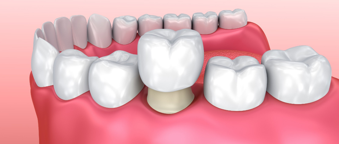 crown placement at Bagita Dental Clinic in Cherkassy