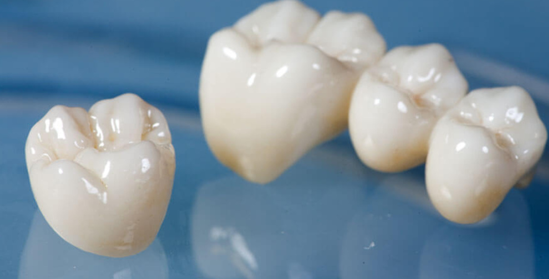crown placement at Bagita Dental Clinic in Cherkassy