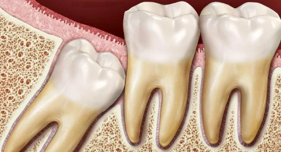 misaligned wisdom teeth photo