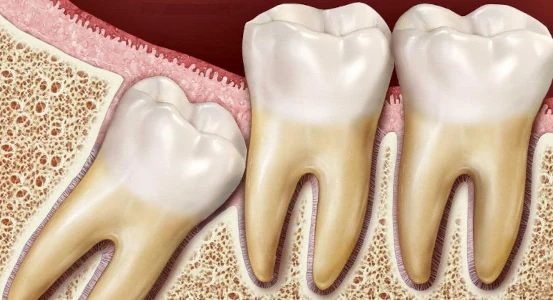 неправильное расположение зубов мудрости фото