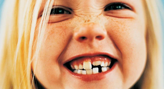 girl's overbite photo