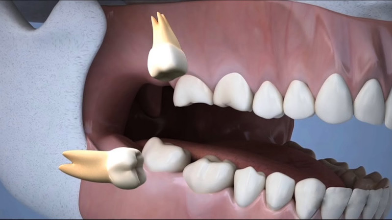 wisdom teeth questions