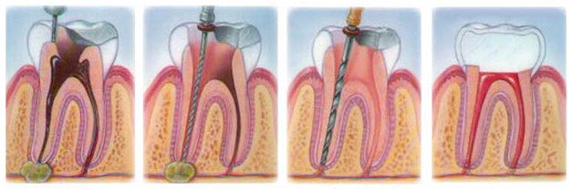 pulpitis treatment in Cherkassy